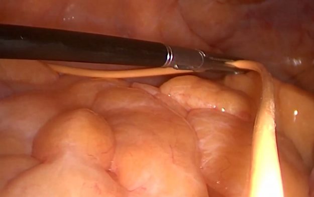 Λαπαροσκοπική τοποθέτηση περιφερικού καθετήρα βαλβίδας