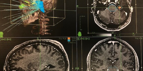 Ενδοκαναλικό ακουστικό νευρίνωμα 13