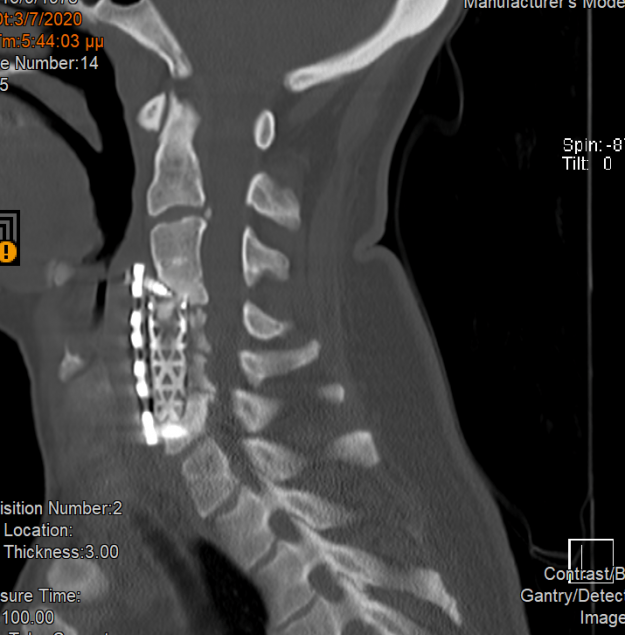 Ψευδάρθρωση μετά από σωματεκτομή ΑΜΣΣ