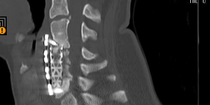 Ψευδάρθρωση μετά από σωματεκτομή ΑΜΣΣ