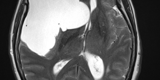 Αραχνοειδής Κύστη Εγκεφάλου