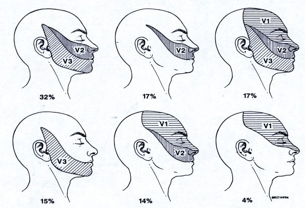 Κατανομή πόνου νευραλγία τριδύμου Κατανομή πόνου νευραλγία τριδύμου