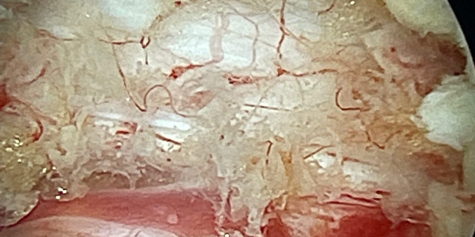 Διακρίνεται μέσα από το ενδοσκόπιο η πλήρης αποσυμπίεση της ερεθισμένης και ταλαιπωρημένης λόγω της χρόνιας πίεσης Ο5 ρίζας δεξιά.