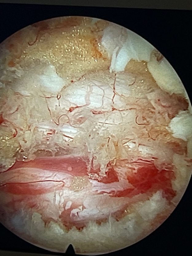 Διακρίνεται μέσα από το ενδοσκόπιο η πλήρης αποσυμπίεση της ερεθισμένης και ταλαιπωρημένης λόγω της χρόνιας πίεσης Ο5 ρίζας δεξιά.