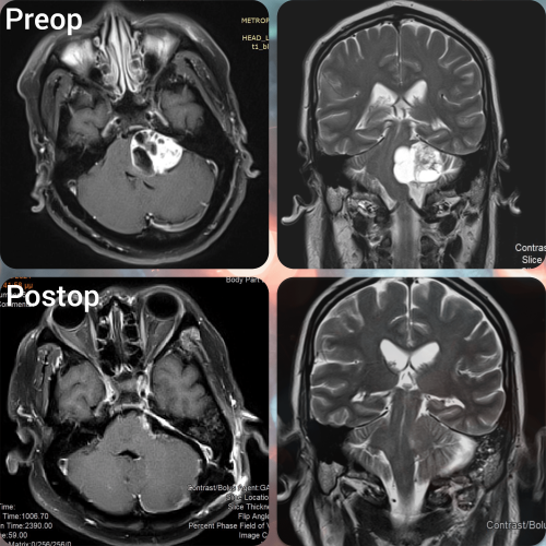 Preoperative and postoperative images of vestibular schwannoma surgery