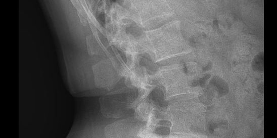 Μετεγχειρητική ακτινογραφία ALIF