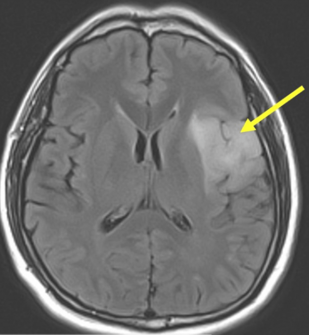 low grade glioma