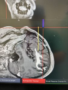 σχεδιασμός αντιμετώπισης όγκου εγκεφάλου με λέιζερ (laser)